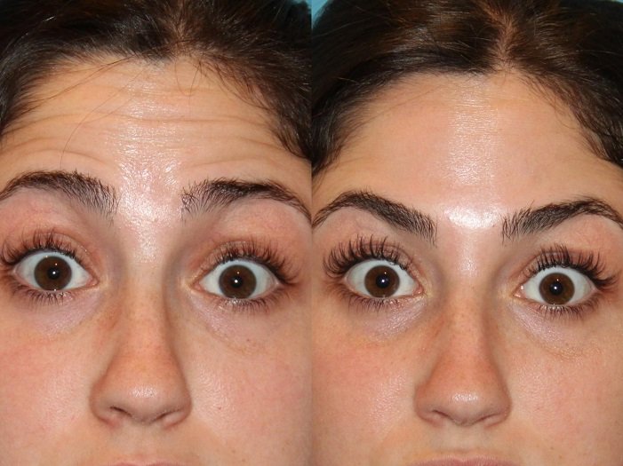 botox before and after forehead