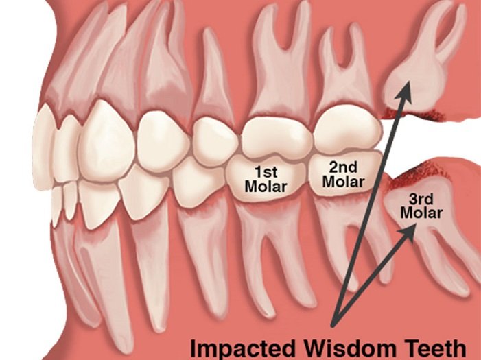 why are wisdom teeth called wisdom teeth